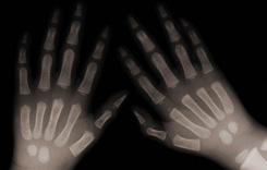 Hand x-ray